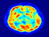 Hiperactividad y consumo de drogas no comparten redes neuronales